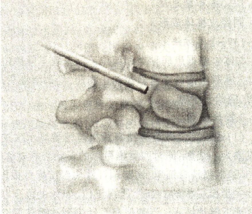 第五节 经皮椎体成形术和球囊扩张椎体后凸成形术